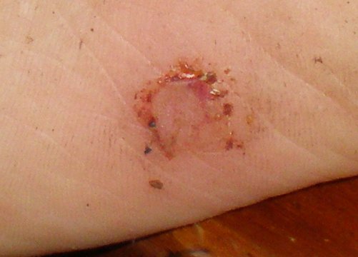 Close up of gash showing the wound after 12 hours of application of dried cayenne pepper.  Now able to walk fine without pain.